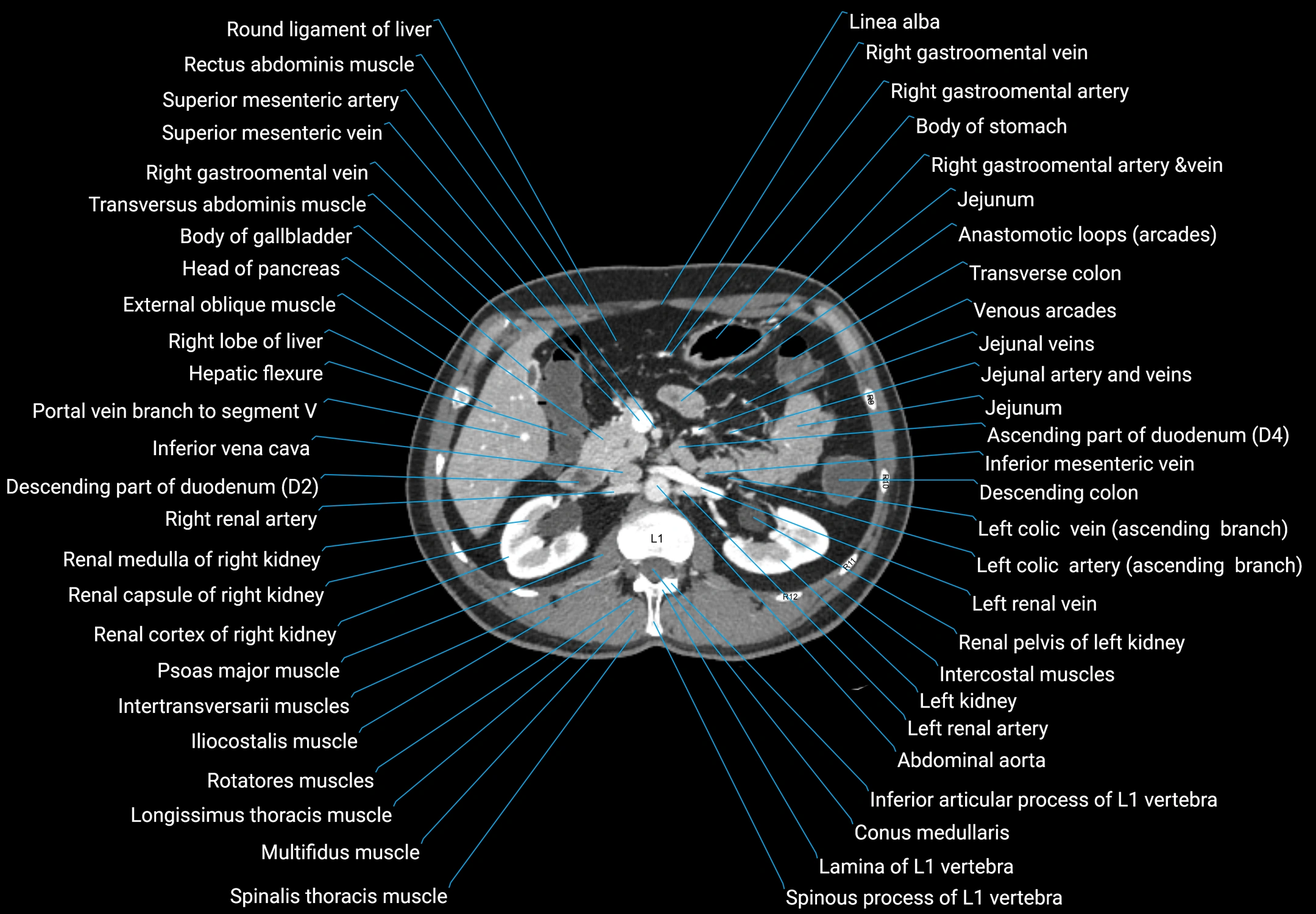 CT male pelvis axial cross sectional anatomy labelled radiology image -00063.webp